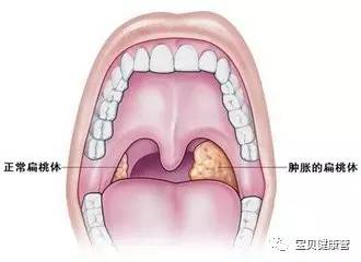 扁桃体化脓怎么治_儿童扁桃体化脓引起发烧怎么办_扁桃体化脓吃什么药