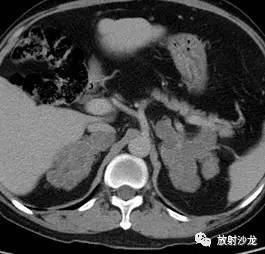 大结节性增生,生姜征肾上腺结核:双侧肾上腺结核往往病变范围较小