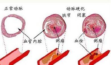 动脉粥样硬化的六点诱因