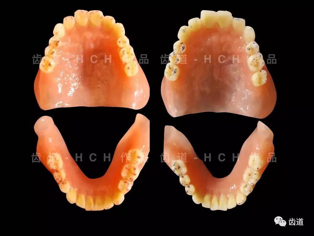 多流程取印模及颌位关系全口病例齿道-hch全口义齿实战培训基础班3.