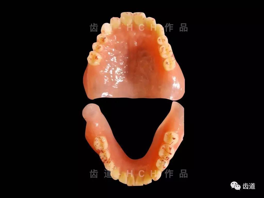 多流程取印模及颌位关系全口病例齿道-hch全口义齿实战培训基础班3.