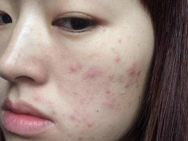 前几天放假的时候,一位女大学生客户,满脸痘痘,还有痘印.