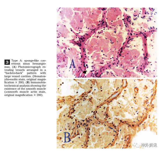海绵状血管瘤你搞清楚了吗