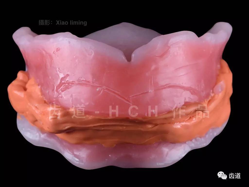 多流程取印模及颌位关系全口病例齿道-hch全口义齿实战培训基础班3.