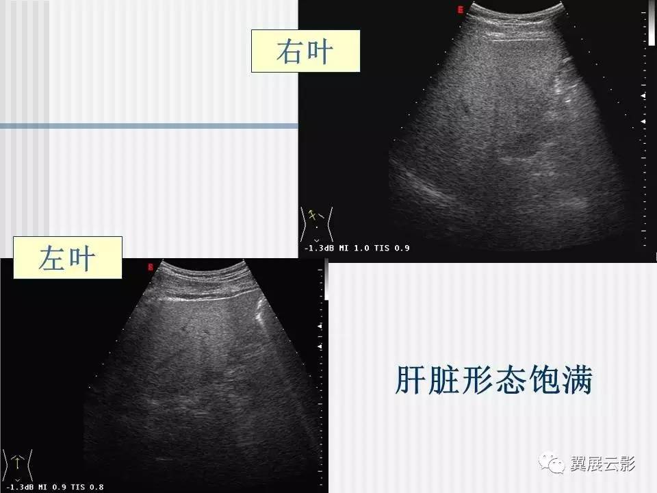 脂肪肝的影像学诊断