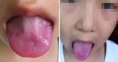 宝宝舌头暗示的疾病,妈妈们自测一下