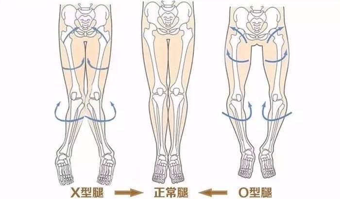 o型腿看过来,这里有一份矫正指南!