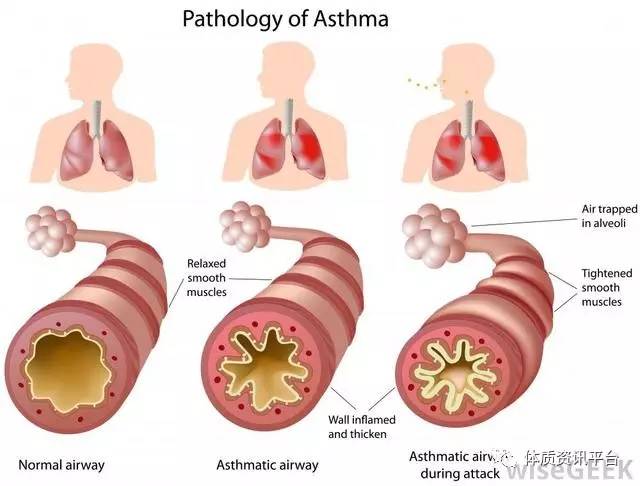 过敏性哮喘犯了怎么办