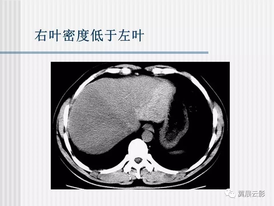 脂肪肝的影像学诊断