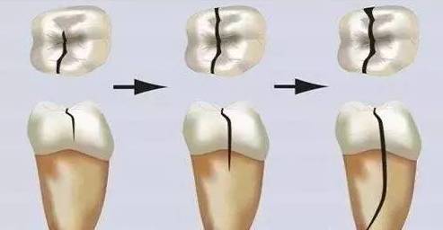 牙齿开裂的原因及治疗方法