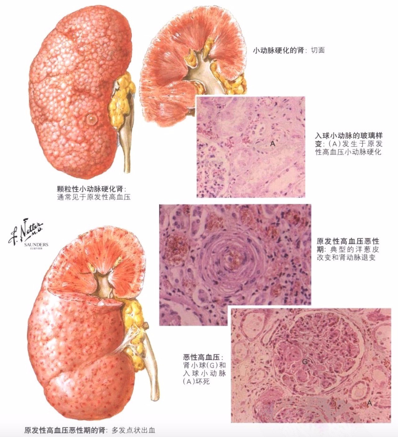 8,大瘢痕肾见于动脉粥样硬化,因动脉粥样硬化累及大,中动脉,坏死区域