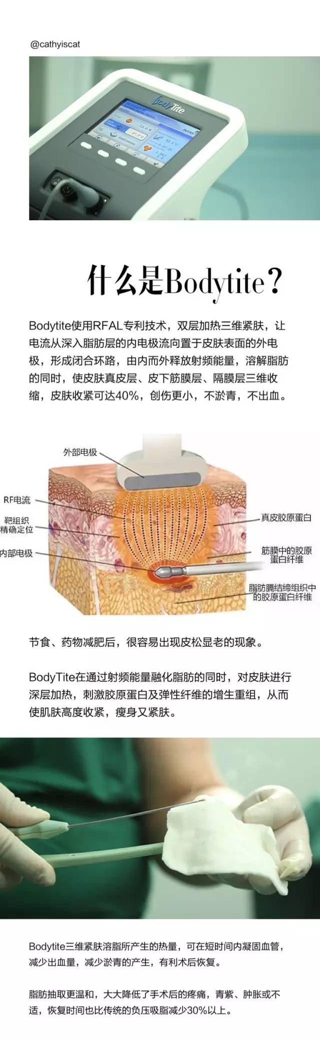 整形日记 | 面部吸脂 bodytite ( 上)