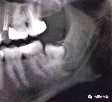 远中倾斜第三磨牙