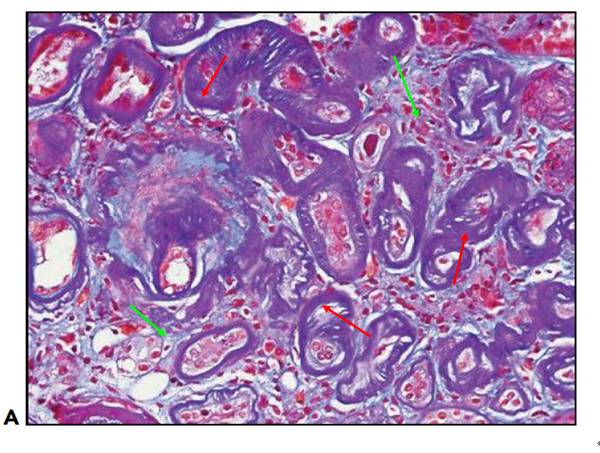 masson染色:红色箭头:肾小管基底膜增厚;绿色箭头:肾间质纤维化