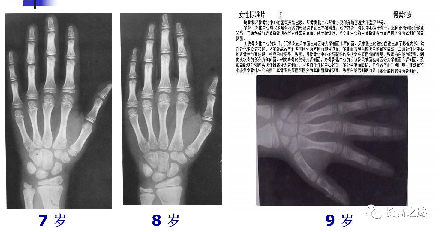 手指关节处长了个骨头 10年了 附X光片_百度知道
