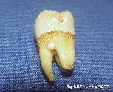 多位于磨牙根分叉或其附近,或见于釉牙骨质界附近的根面上.
