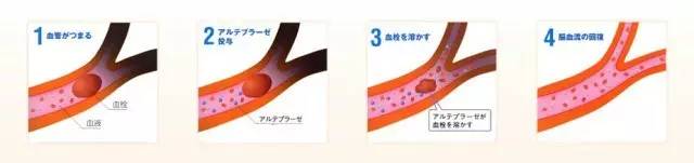 5小时内的患者静脉溶栓治疗获益最大,但也存在出血,溶栓血管不通等