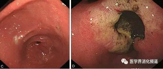 白光内镜下发现早期胃癌的技巧干货满满