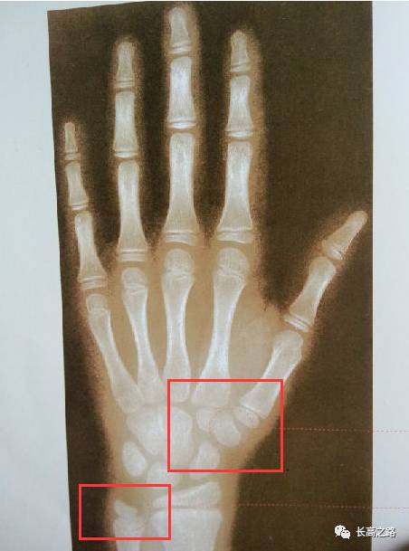 骨龄13岁怎么看的