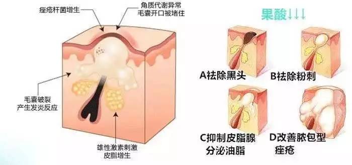 闭口会慢慢自己消失吗