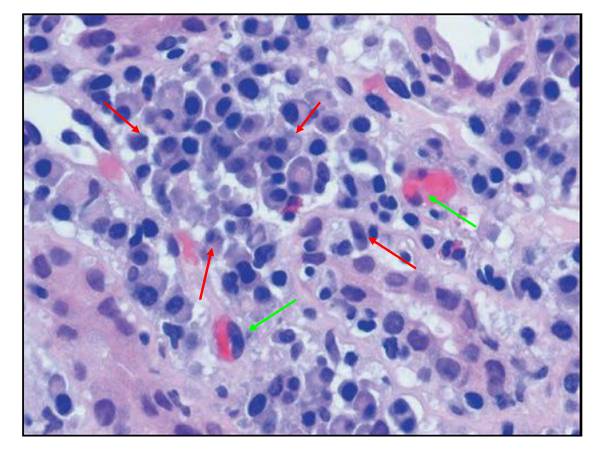 he染色:红色箭头:肾间质大量浆细胞浸润;绿色箭头:肾间质嗜酸性粒细胞