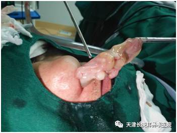 在刘院长及各手术医生精准操作的努力之下,李老伯的巨大鼻息肉被取了