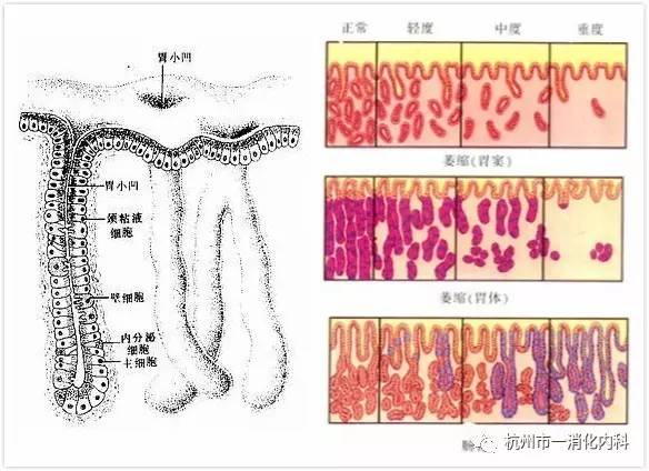 胃黏膜上皮异型增生与早期胃癌关系的临床病理研究7