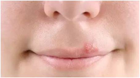 唇疱疹是一种充满液体的水泡,突发于嘴唇,鼻下或下颌附近,由单纯疱疹