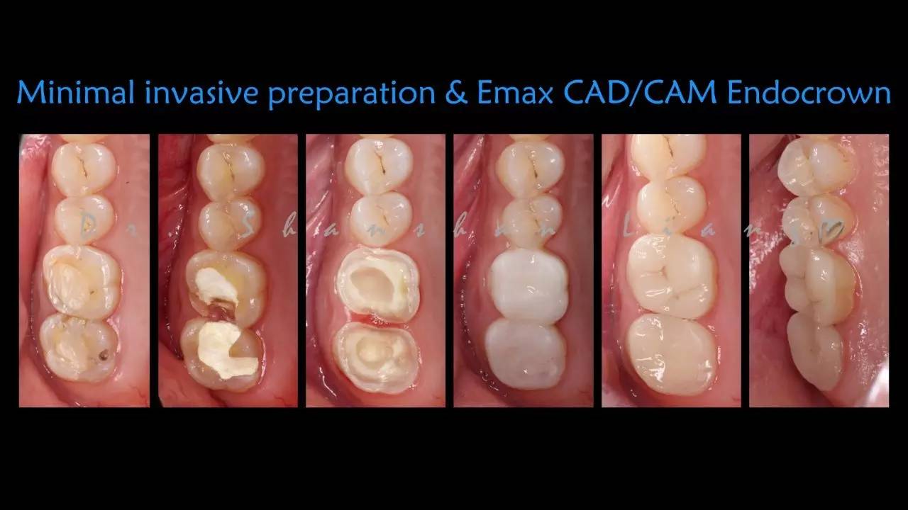 学员实操(仿真头颅模型):后牙cad/cam瓷嵌体及高嵌体的牙体预备; 6.