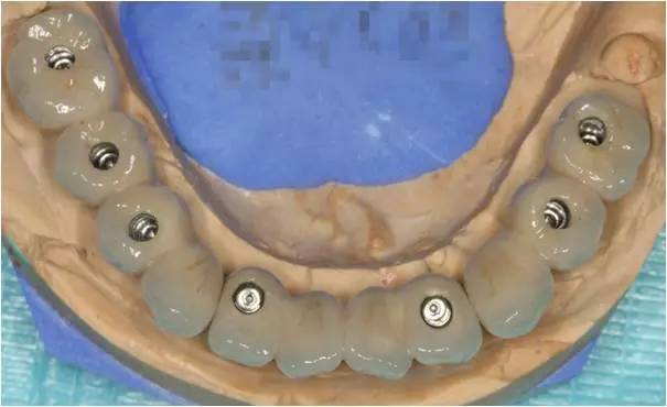 下颌用全口活动义齿加软衬做临时修复体,3个月后进行种植固定修复,桥