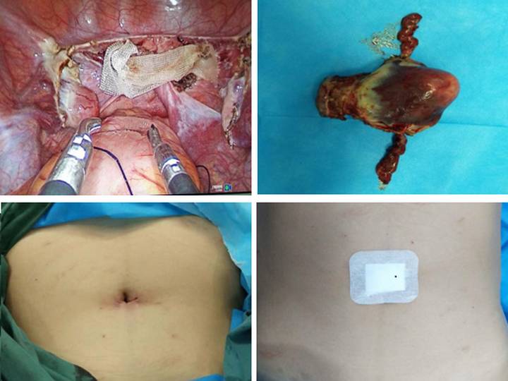 妇科成功完成一例单孔腹腔镜下全子宫切除术