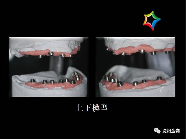 全口无牙颌种植螺丝固位桥架修复病例