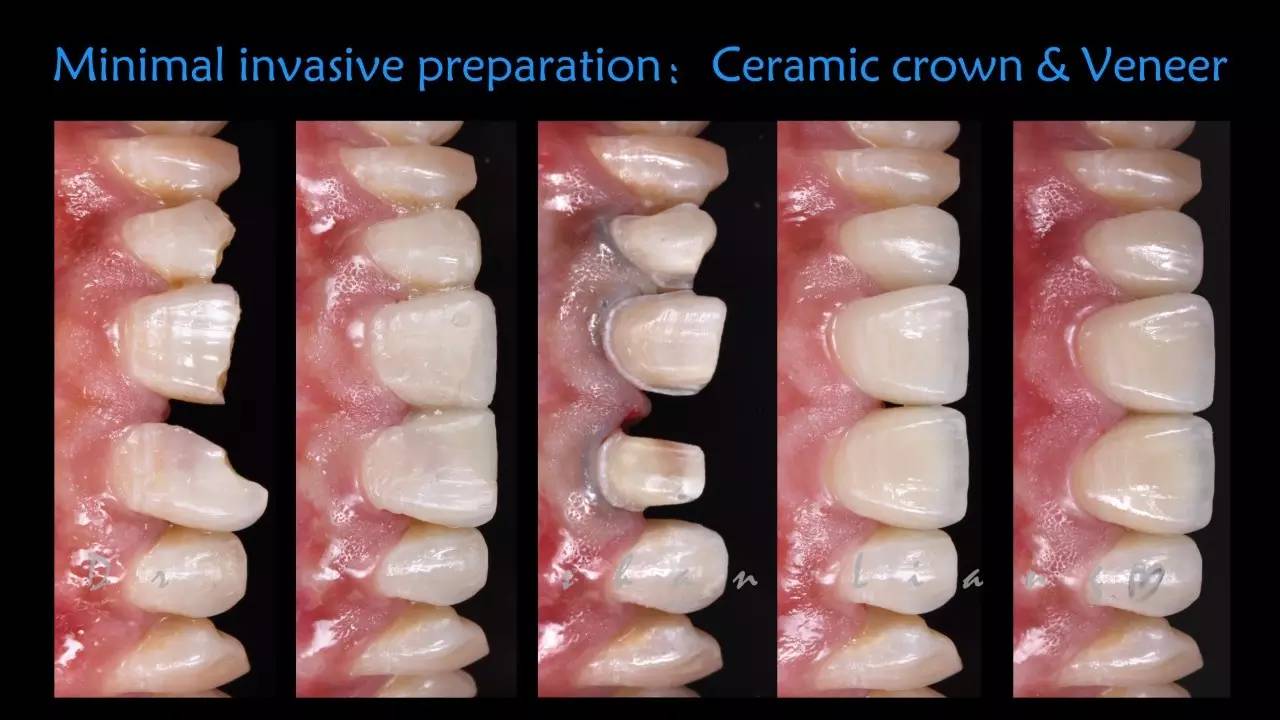 普洁修复课微创修复的牙体预备深圳站教你掌握瓷贴面及嵌体的牙体预备