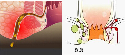 早期肛瘘的清晰图片（早期肛瘘图片）