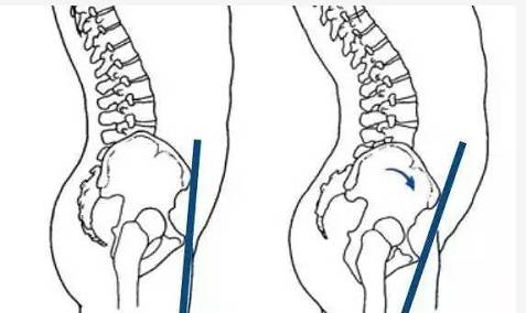 如何判断骨盆前倾