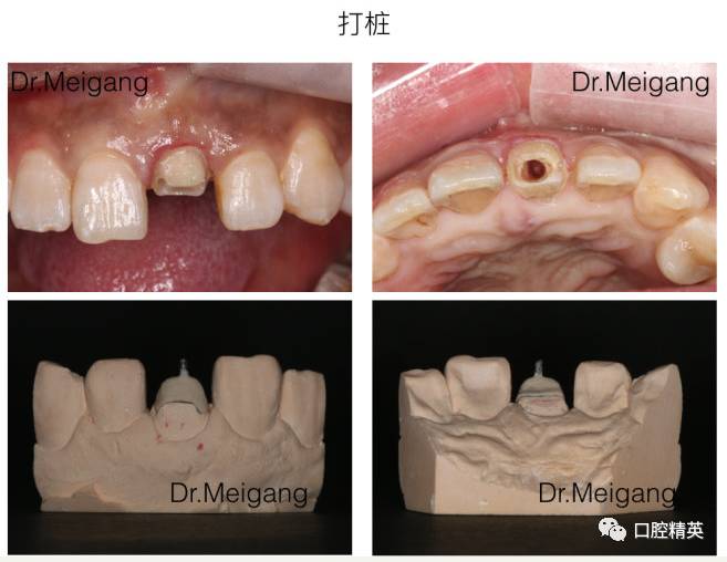 前牙全瓷单冠修复