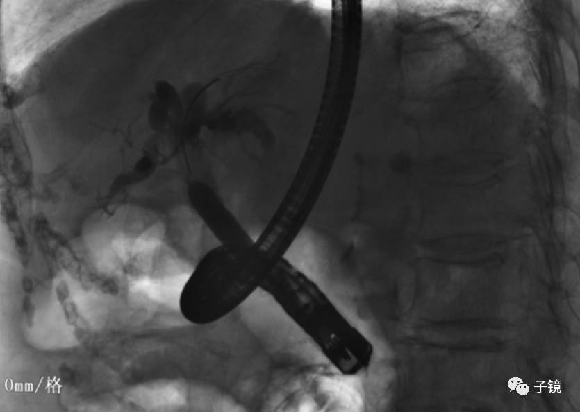 呈est术后状态,胆管插管顺利,透视下注入适量造影剂观察见胆总