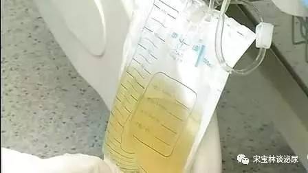 宋宝林医生   膀胱冲洗(bladder irrigation)   利用导尿管,将溶液