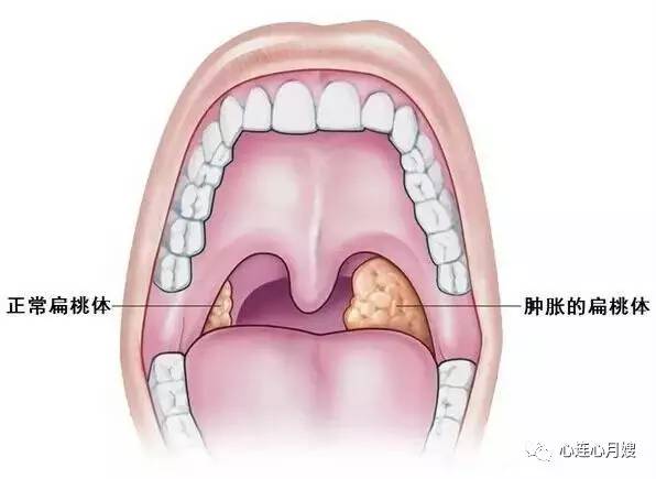 儿童扁桃体发炎 如何预防?