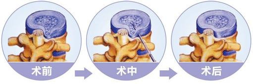 惊,腰椎间盘突出了按摩可能会导致瘫痪!