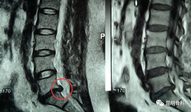 确诊:腰间椎盘突出症合并侧隐窝狭窄