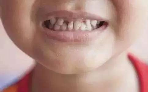 口腔科副主任医师袁凯仔细检查后发现, 尧尧是牙齿最外表的保护层已经