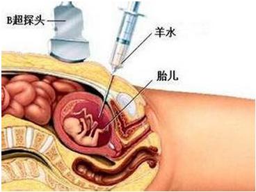 羊水穿刺检查胎儿死亡率1%