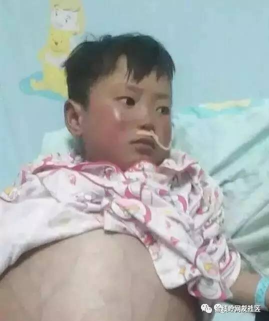 宜宾邻县一8岁男孩患怪病肚子大过皮球,父母急求帮忙!