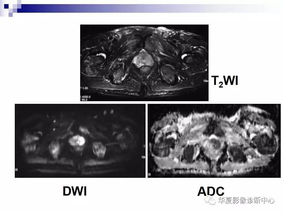 【影像基础】前列腺癌的mri诊断(下)