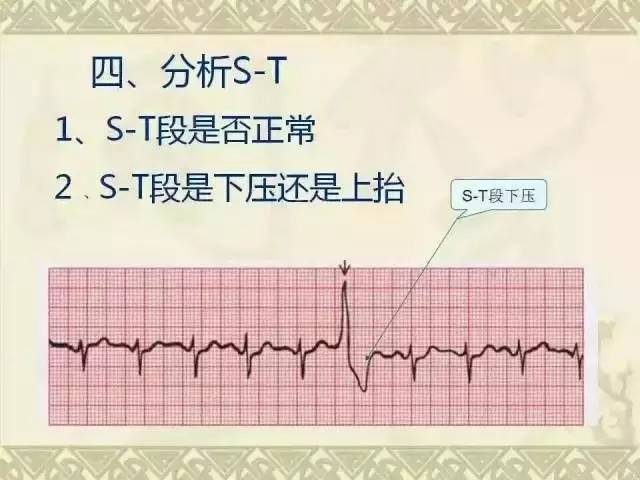 收藏!心电图经典图谱