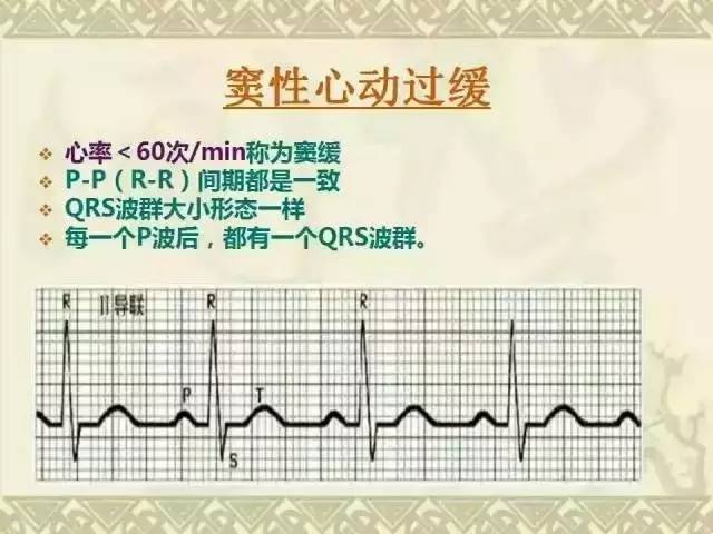 收藏!心电图经典图谱