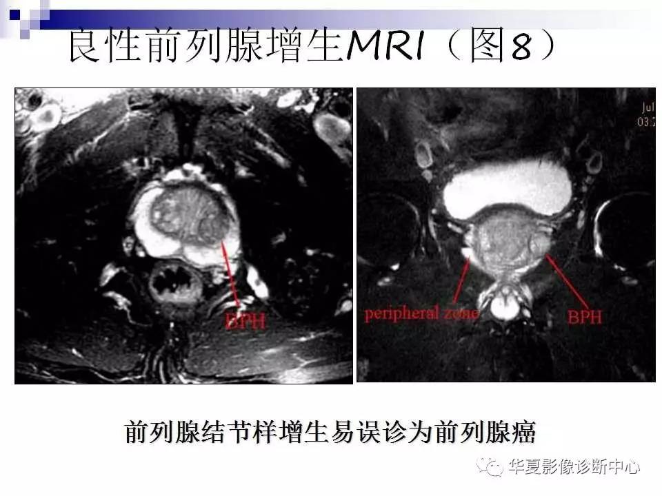 【影像基础】前列腺癌的mri诊断(下)