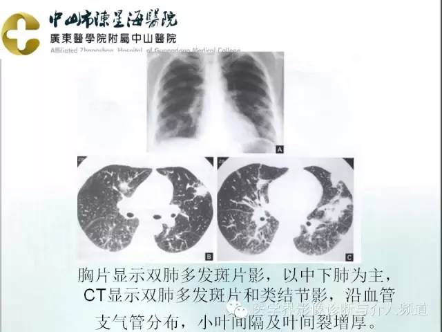 关于肺结节病的那些胸片图,你都看懂了吗?