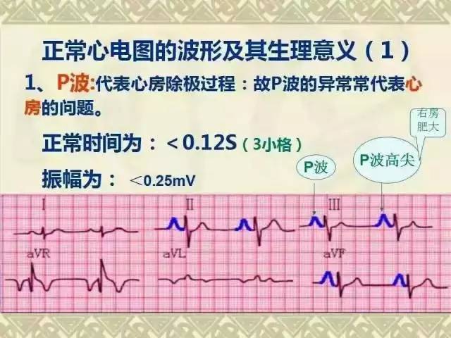 收藏!心电图经典图谱